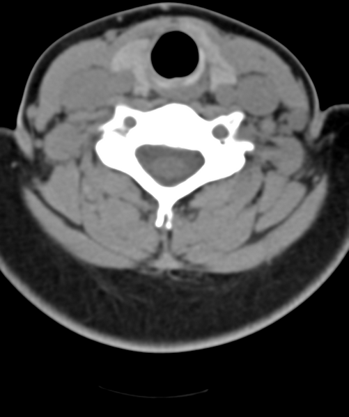 File:Normal cervical spine MRI (including Dixon) (Radiopaedia 42762-45926 Axial non-contrast 39).png