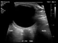 Normal eye ultrasound (Radiopaedia 70415-80514 A 3).jpg