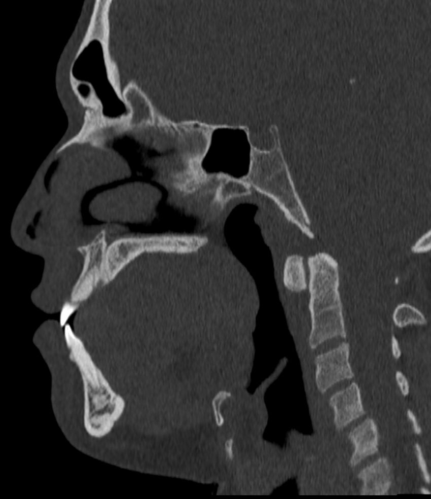 Normal facial bone CT (Radiopaedia 88742-105476 Sagittal bone window 86).jpg
