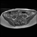 Normal female pelvis MRI (retroverted uterus) (Radiopaedia 61832-69933 Axial T1 6).jpg