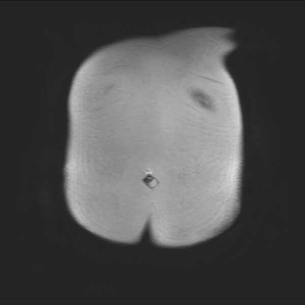 File:Normal liver MRI with Gadolinium (Radiopaedia 58913-66163 Coronal T2 3).jpg