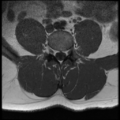 Normal lumbar spine MRI (Radiopaedia 35543-37039 Axial T1 16).png