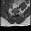 Normal lumbar spine MRI (Radiopaedia 35543-37039 Axial T1 8).png
