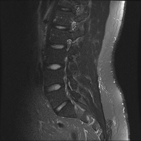 File:Normal lumbar spine MRI (Radiopaedia 43051-46311 Sagittal STIR 14).jpg