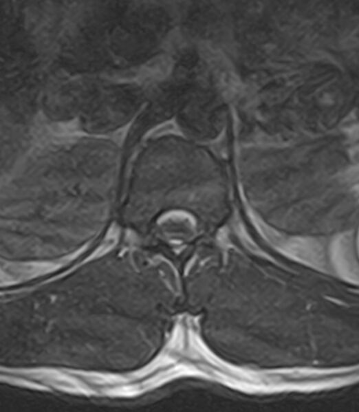 File:Normal lumbar spine MRI - low-field MRI scanner (Radiopaedia 40976-43699 Axial T2 9).jpg