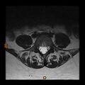 Normal spine MRI (Radiopaedia 77323-89408 Axial T2 19).jpg