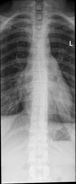 File:Normal thoracic spine (Radiopaedia 40136-42642 Frontal 1).png
