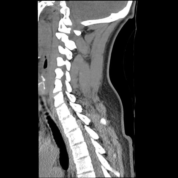 File:Normal trauma spine imaging (Radiopaedia 31753-32686 A 26).jpg