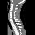 Normal trauma spine imaging (age 16) (Radiopaedia 45335-49358 C 19).jpg