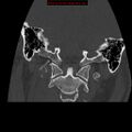 Occipital condyle fracture (Radiopaedia 18366-18208 Coronal bone window 11).jpg