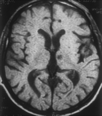 Left subthalamic nucleus stroke caused contralateral hemiballism.