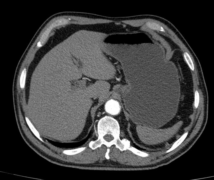 File:Abdominal aortic aneurysm (Radiopaedia 22421-22458 C+ arterial phase 3).jpg