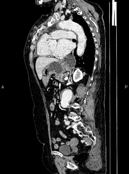 File:Abdominal aortic aneurysm (Radiopaedia 85063-100606 Sagittal C+ arterial phase 50).jpg
