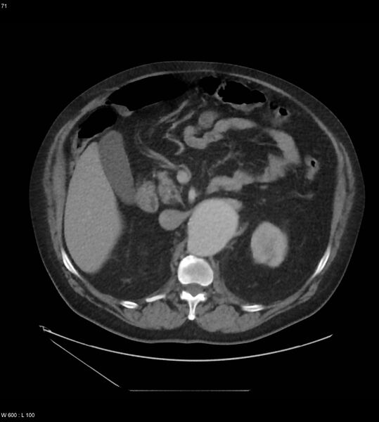 File:Abdominal aortic aneurysm with intramural hematoma then rupture (Radiopaedia 50278-55631 Axial C+ arterial phase 62).jpg