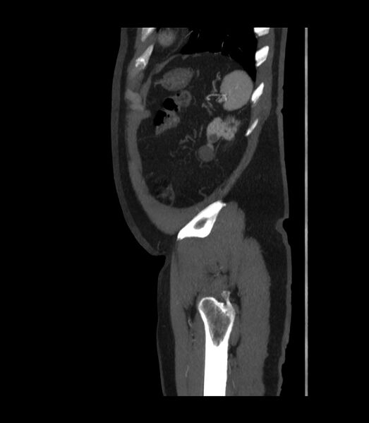 File:Abdominal aortic aneurysm with thrombus fissuration (Radiopaedia 46218-50618 Sagittal C+ arterial phase 52).jpg