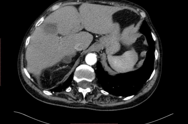 File:Abdominal aortic interposition tube graft and aneurysm thrombosis (Radiopaedia 71438-81857 Axial C+ arterial phase 1).jpg