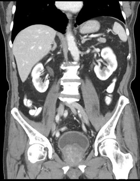File:Abdominal wall metastasis from colorectal carcinoma (Radiopaedia 31016-31717 Coronal C+ portal venous phase 27).jpg