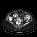 Abdominal wall recurrence after colorectal resection for cancer (Radiopaedia 23444-23523 Axial C+ portal venous phase 20).jpg