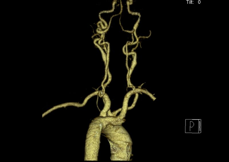 File:Aberrant right subclavian artery (Radiopaedia 19283-19294 3D reconstruction C+ arterial phase 23).jpg