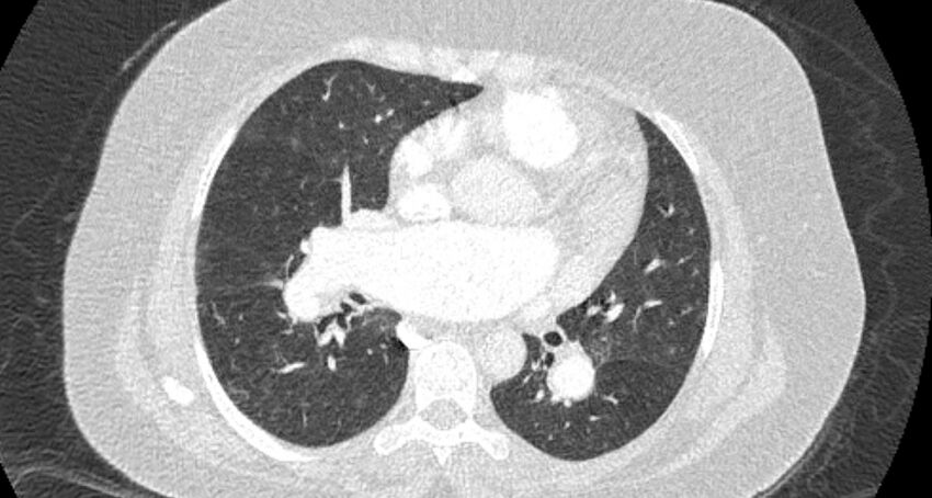 Accessory right inferior hepatic vein (Radiopaedia 65245-74259 Axial lung window 37).jpg