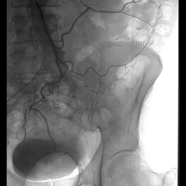 File:Active colonic bleed on CT (Radiopaedia 49765-55026 post coil Inferior mesenteric artery 1).jpg