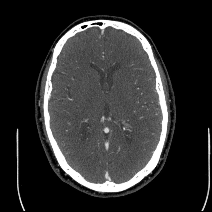Acute A3 occlusion with ACA ischemic penumbra (CT perfusion) (Radiopaedia 72036-82527 Axial C+ arterial phase thins 65).jpg