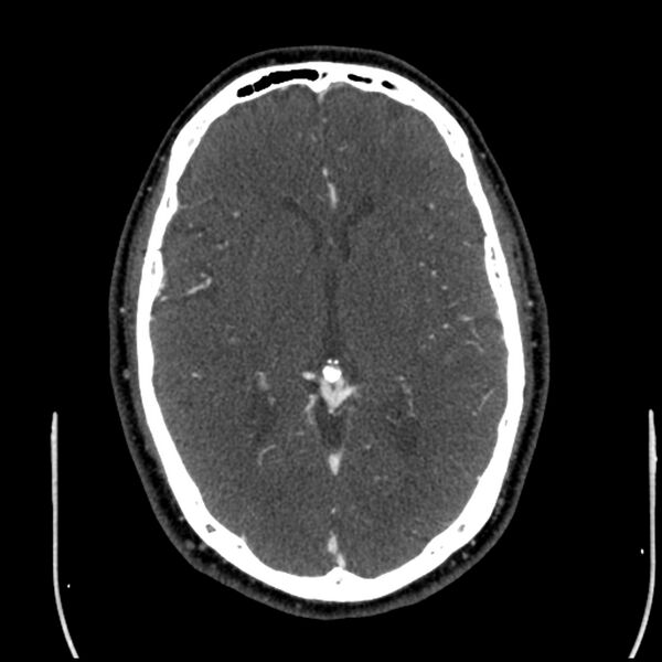 File:Acute A3 occlusion with ACA ischemic penumbra (CT perfusion) (Radiopaedia 72036-82527 Axial C+ arterial phase thins 72).jpg