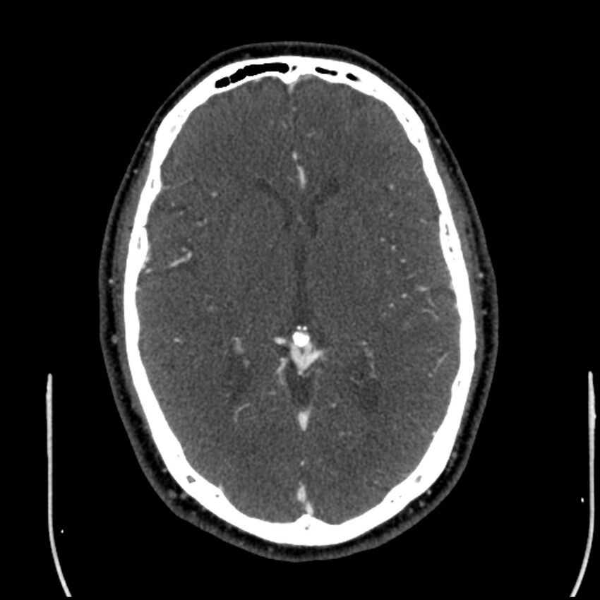 Acute A3 occlusion with ACA ischemic penumbra (CT perfusion) (Radiopaedia 72036-82527 Axial C+ arterial phase thins 72).jpg