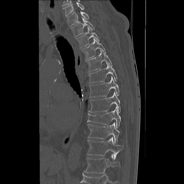 File:Acute and chronic vertebral compression fractures (Radiopaedia 31608-32494 Sagittal bone window 8).jpg