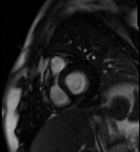 File:Acute anteroseptal myocardial infarction (Radiopaedia 68409-77945 Short axis (basal) Perfusion 8).jpg