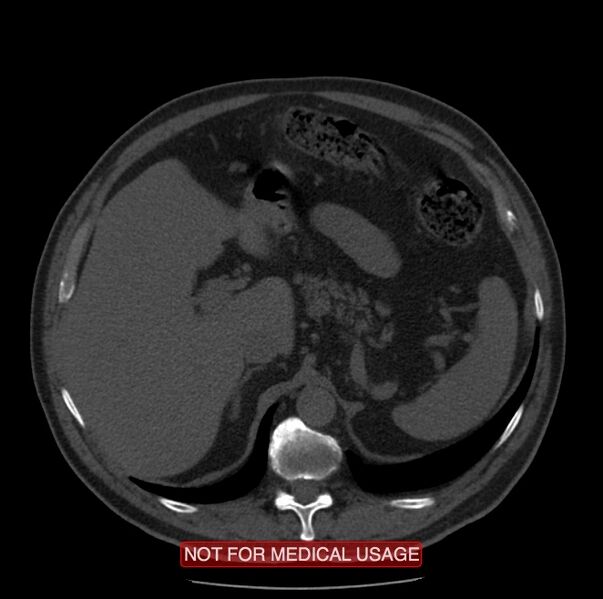 File:Acute aortic dissection - Stanford type A (Radiopaedia 40661-43285 Axial non-contrast 79).jpg