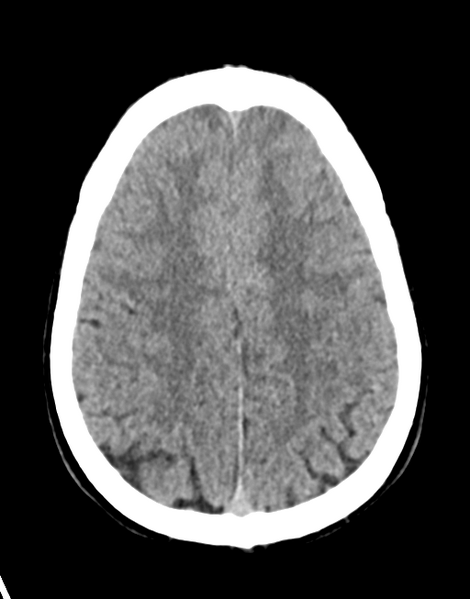 File:Acute disseminated encephalomyelitis (ADEM) (Radiopaedia 65319-74348 Axial non-contrast 24).png