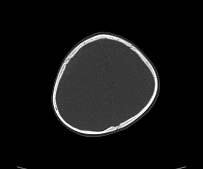 Acute hemorrhagic contusion (Radiopaedia 63660-72336 Axial bone window 55).jpg