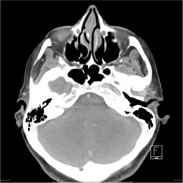 File:Acute left parotid sialadenitis (Radiopaedia 26160-26295 C+ arterial phase 2).jpg