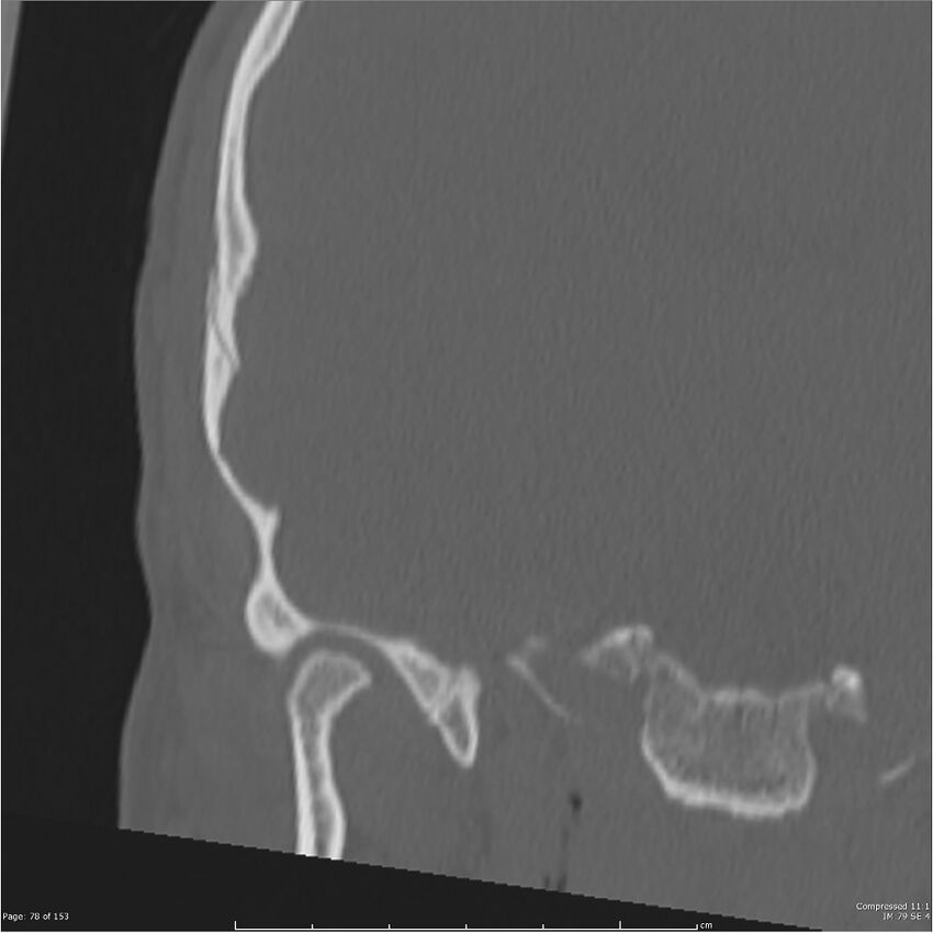 Acute otomastoiditis (Radiopaedia 28276-28512 Coronal PTB bone window reformat 9).jpg