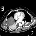 Acute pancreatic necrosis (Radiopaedia 13560-13486 Axial C+ portal venous phase 7).jpg