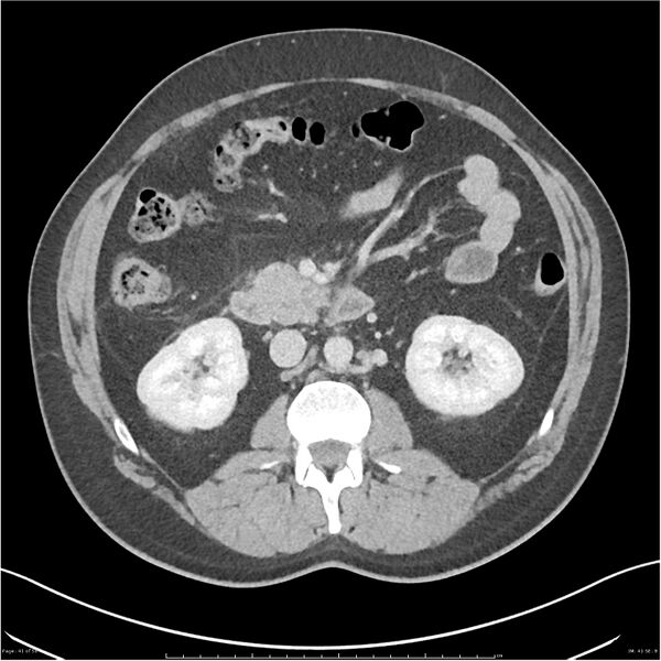 File:Acute pancreatitis - mild (Radiopaedia 27796-28033 C+ portal venous phase 22).jpg