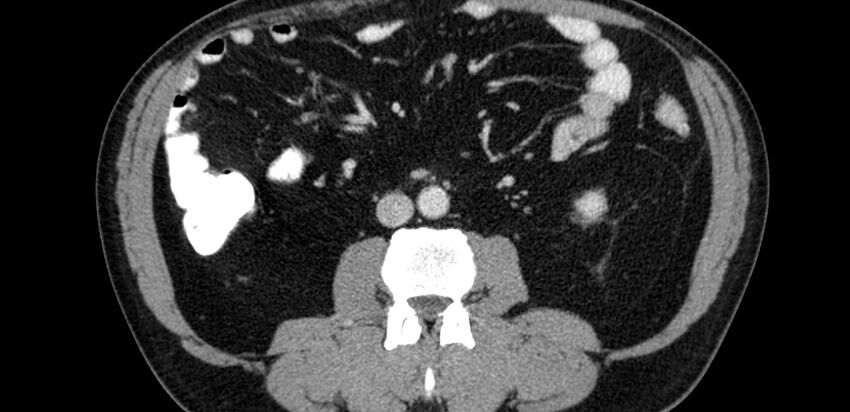 Acute sigmoid colon diverticulitis (Radiopaedia 55507-61976 Axial C+ portal venous phase 20).jpg