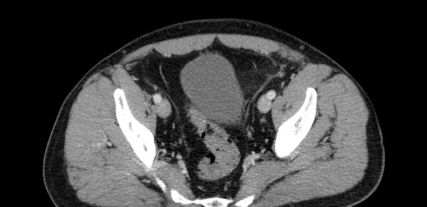 Acute sigmoid colon diverticulitis (Radiopaedia 55507-61976 Axial C+ portal venous phase 96).jpg