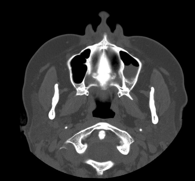 File:Acute sinusitis (Radiopaedia 22419-22455 Axial non-contrast 5).jpg