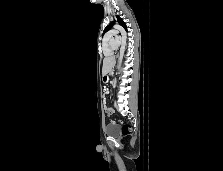 File:Addison disease (Radiopaedia 49318-54412 Sagittal C+ portal venous phase 30).jpg