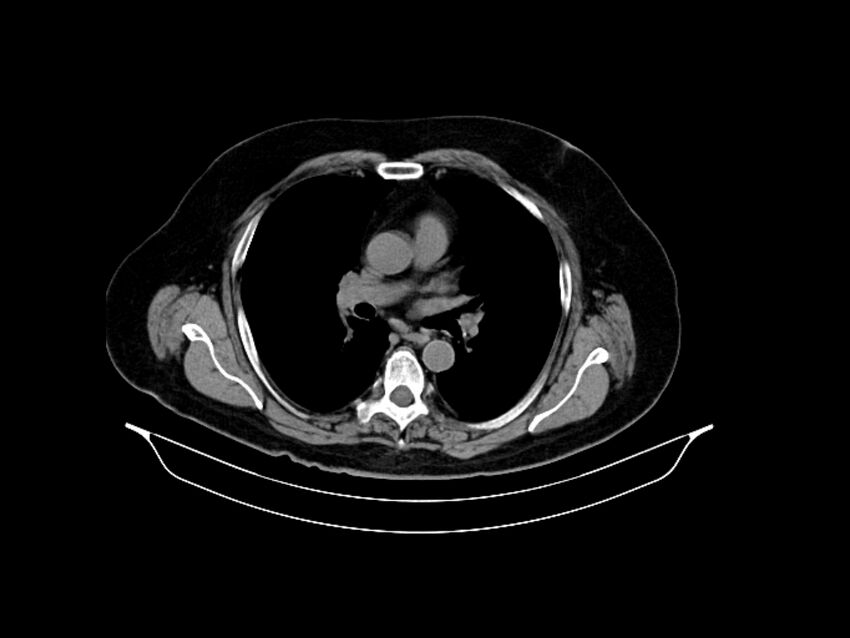 Adenocarcinoma of pancreas with hepatic metastasis (Radiopaedia 64332-73122 Axial non-contrast 3).jpg