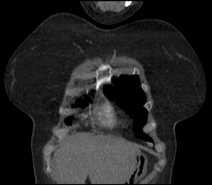 File:Adenocarcinoma of the lung (Radiopaedia 44205-47803 Coronal C+ portal venous phase 10).jpg