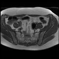 Adenoma malignum of the cervix (Radiopaedia 24460-24765 T1 3).jpg