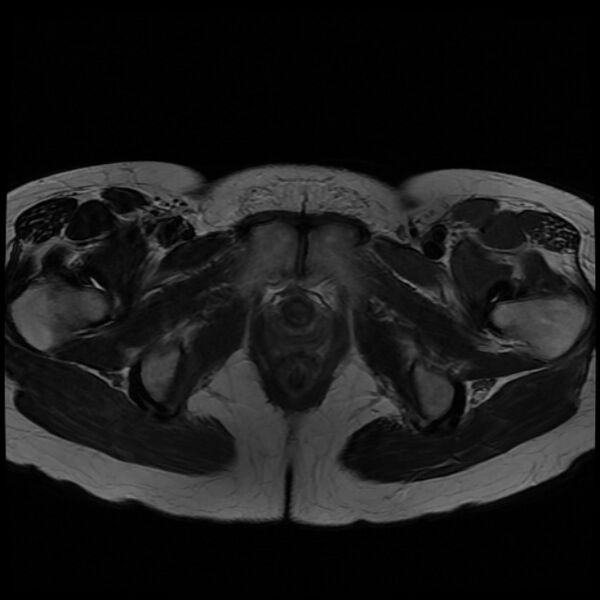 File:Adenomyosis on MRI (Radiopaedia 29328-29780 Axial T2 12).jpg