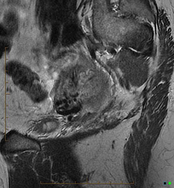 File:Adenomyosis uterus with hematometra (Radiopaedia 45779-50011 Sagittal T2 25).jpg
