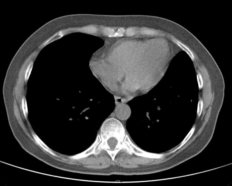 File:Adenosquamous lung carcinoma (Radiopaedia 22035-22030 non-contrast 41).jpg