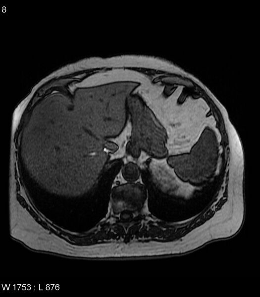 File:Adrenal myelolipoma (Radiopaedia 6765-7961 Axial T1 out-of-phase 8).jpg