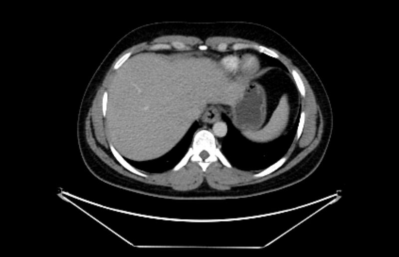 File:Adrenocortical carcinoma (Radiopaedia 80134-93438 Axial C+ portal venous phase 21).jpg