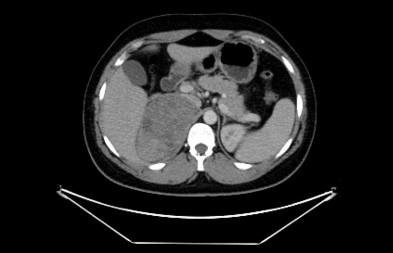 File:Adrenocortical carcinoma (Radiopaedia 80134-93438 Axial C+ portal venous phase 37).jpg